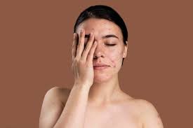 Acne & Rosacea Care