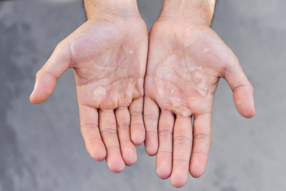 Hyperhidrosis