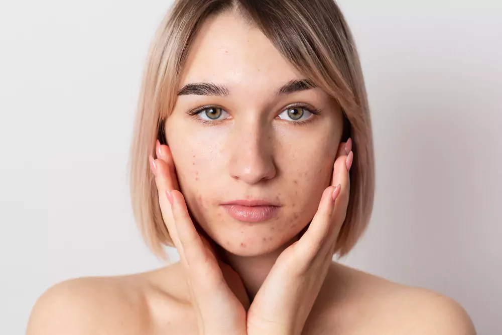 Melasma