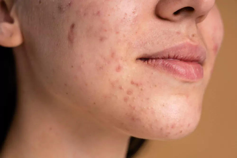 Acne & Rosacea Care