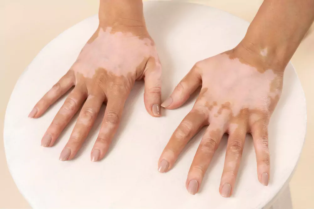 Vitiligo