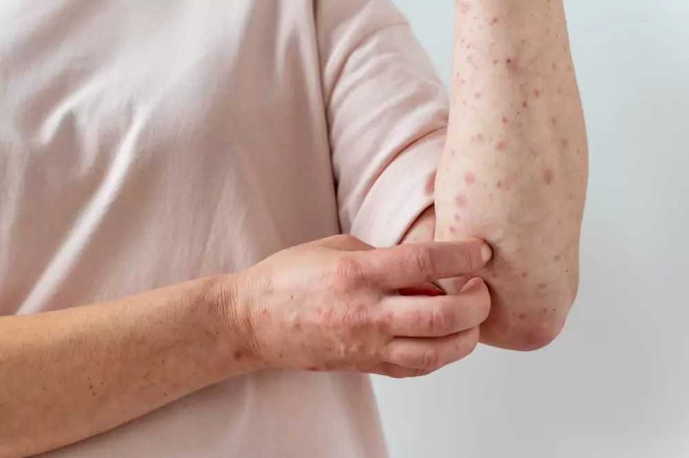Hives (Urticaria)