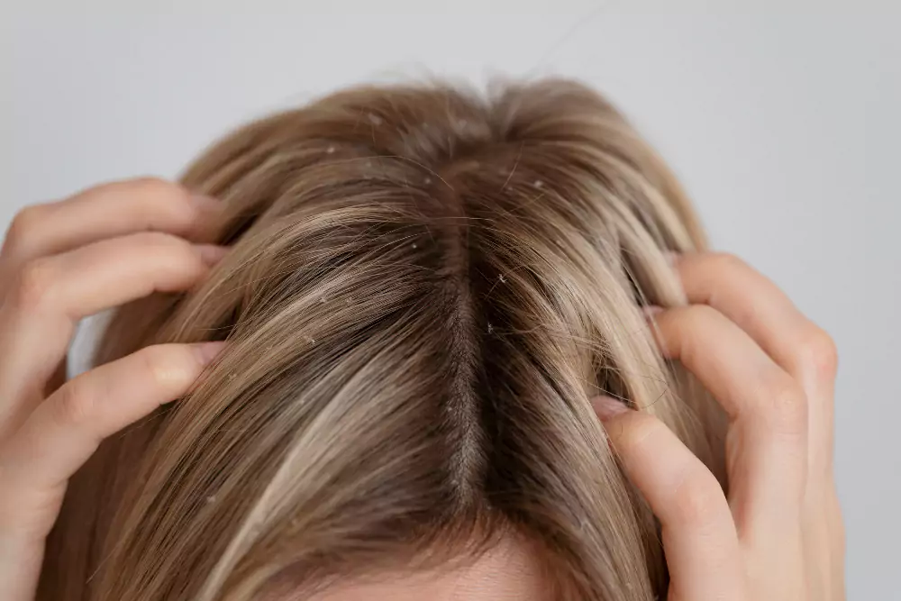Head Lice
