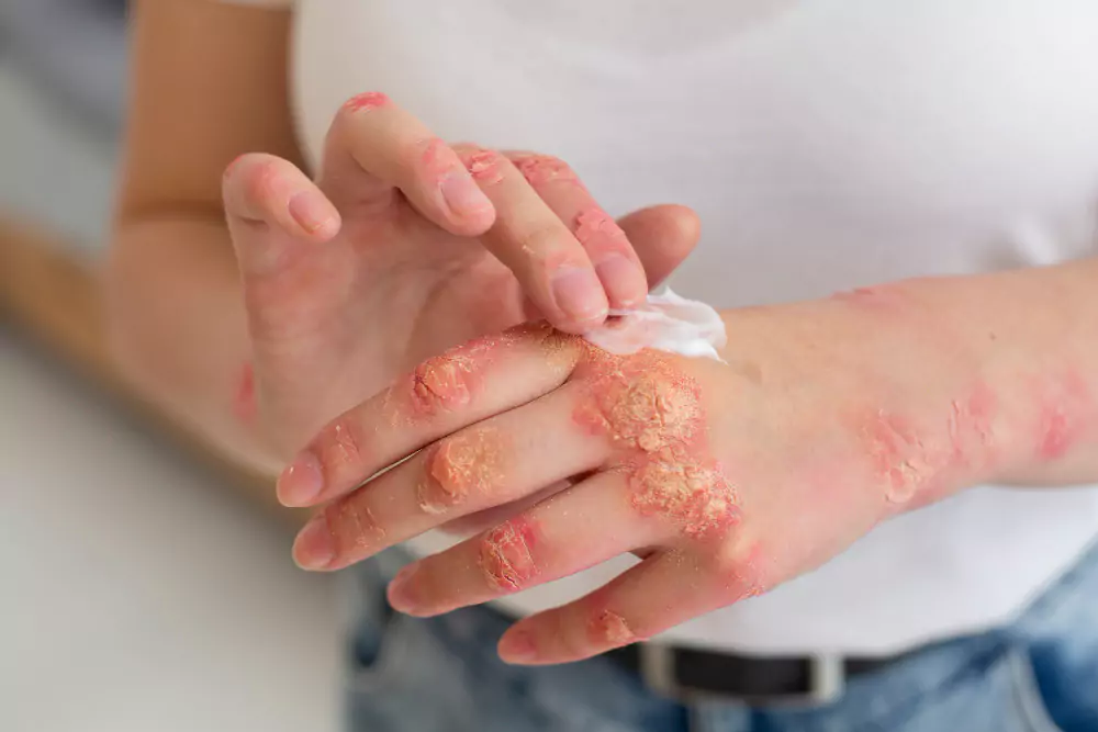 Eczema