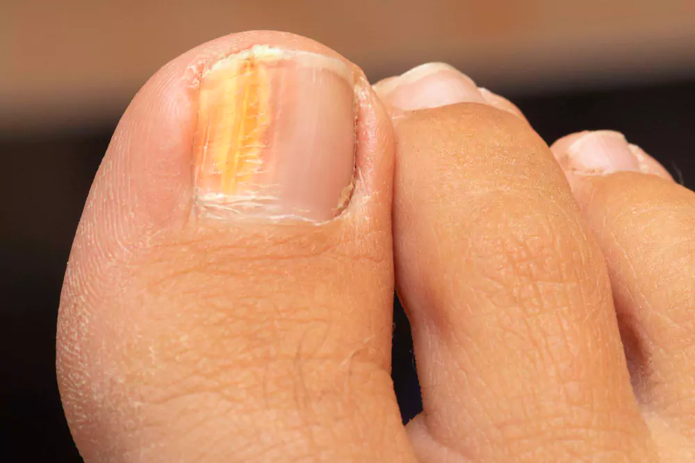 Nail Psoriasis or Fungus