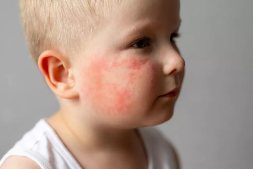 Pediatric skin concerns