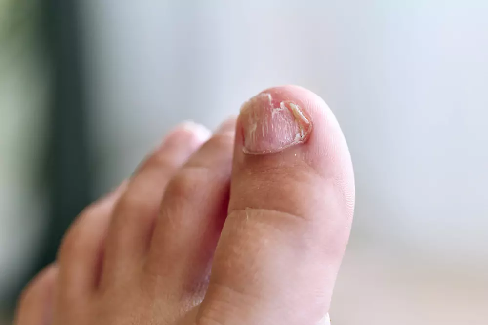 fungal infections!