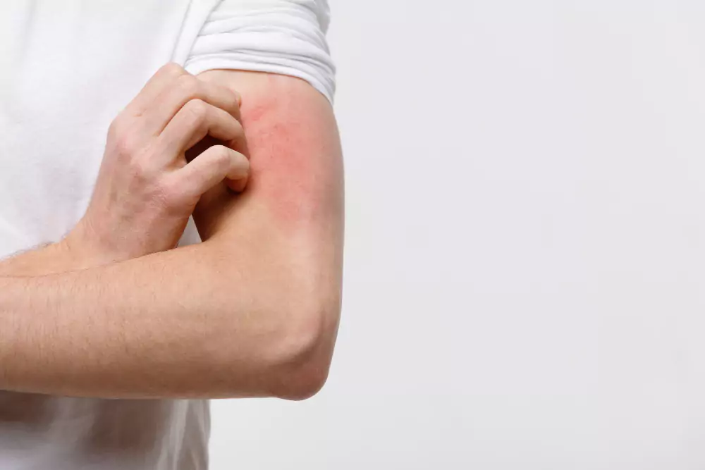 Rash