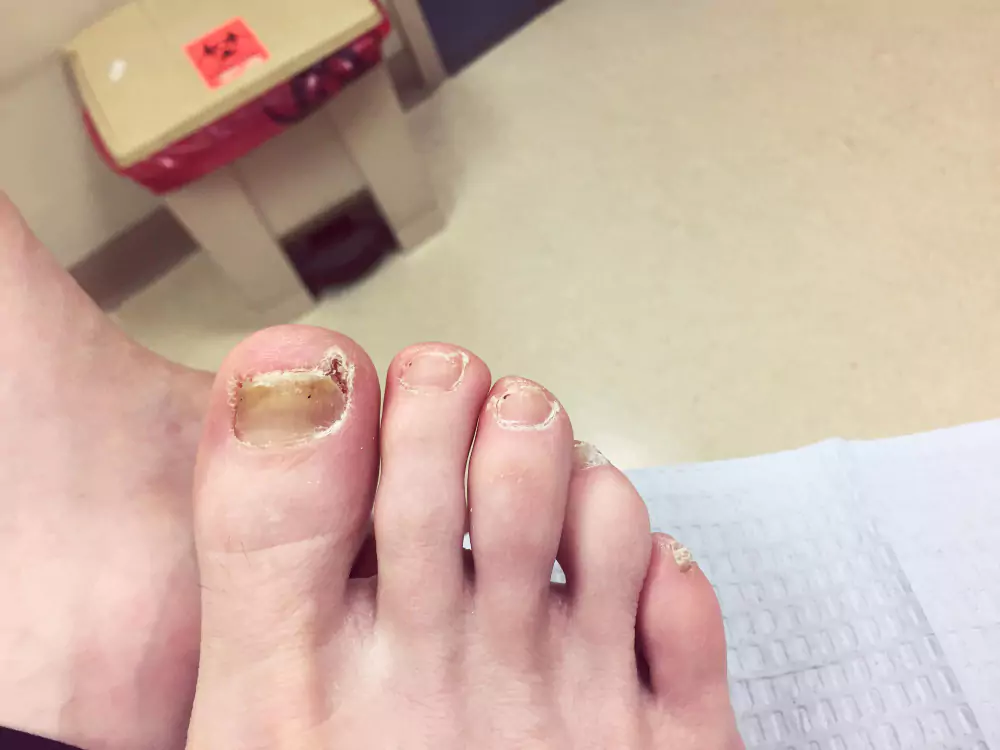 Nail Issues